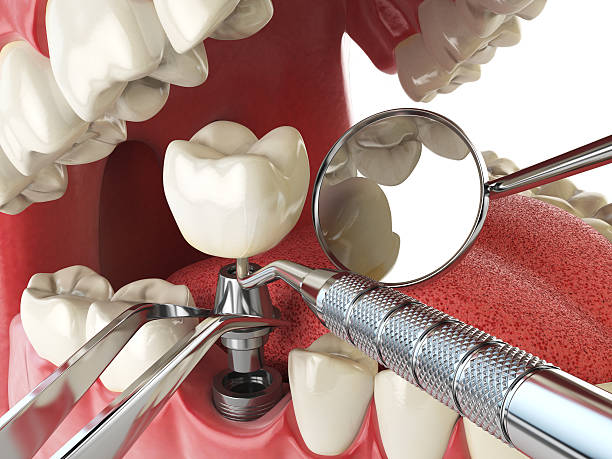 Best Emergency Wisdom Tooth Extraction in Winter Haven, FL